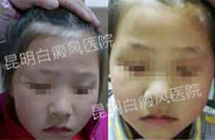 5岁女孩面部白斑6个月