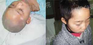 6岁男童面部白斑2年