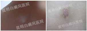 21岁女性背部患白癜风3个月