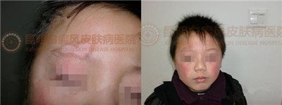 8岁男孩右侧眉上侧白斑1年