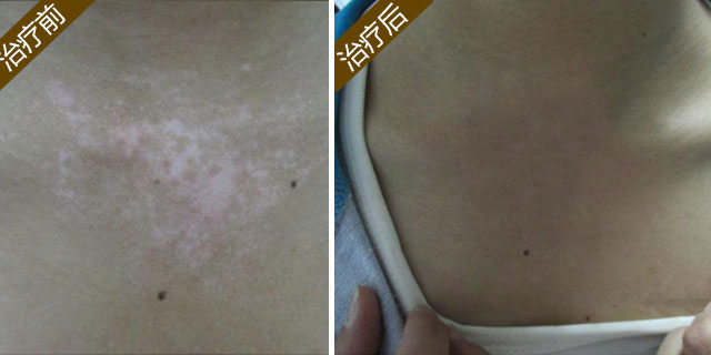 花季少女结束2年白斑摧残